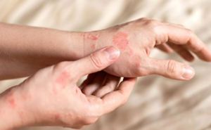 Аллергия и сыпь обеспечены: Врач рассказала почему надо избегать сульфиты — особенно сейчас