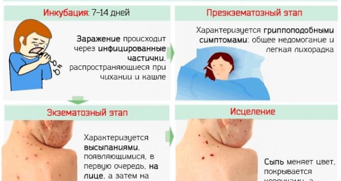 За последнюю неделю корью заразились 51 житель Донецкой и Луганской областей