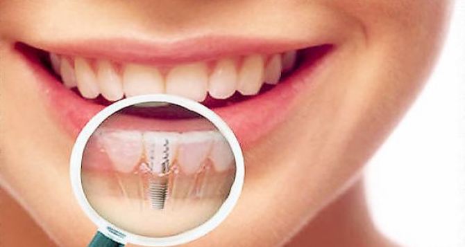 Имплантация зубов в стоматологической клинике Киева