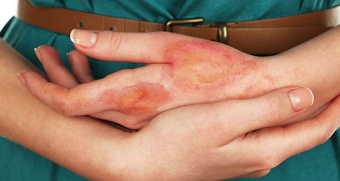 Как стирать при аллергии на стиральный порошок: никаких волдырей на руках, чиха и кашля