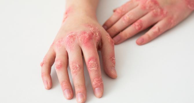 Нездоровая тенденция в чешском обществе Уровень заражения сифилисом в Чехии вырос на