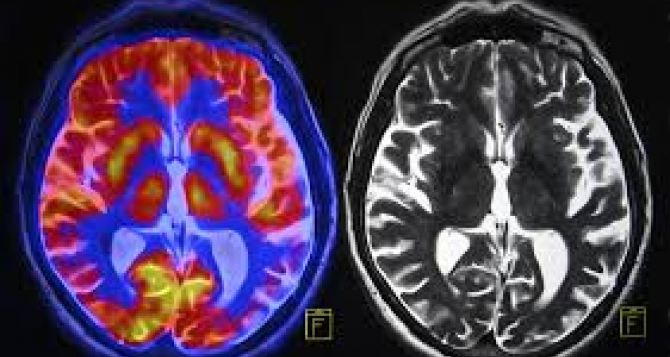 Раскрыт механизм старения мозга Результаты исследования