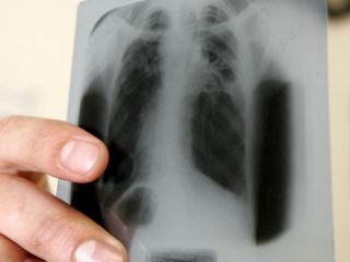 Когда нужно бить тревогу медики рассказали о симптомах туберкулеза