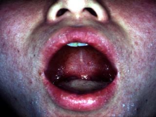 Грозит ли Луганску вспышка кори? 