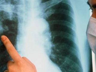 Мужчина заразивший племянницу туберкулезом может сесть на  лет