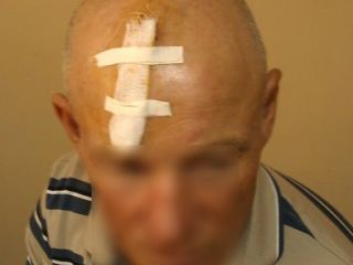 На Луганщине мужчине в драке проломили череп топором